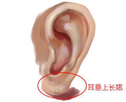 耳朵长上有痣的位置图解，耳朵长痣的位置图解