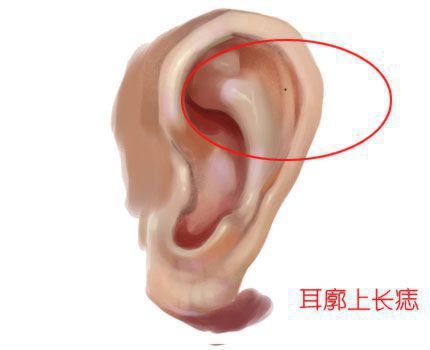 耳朵长上有痣的位置图解，耳朵长痣的位置图解