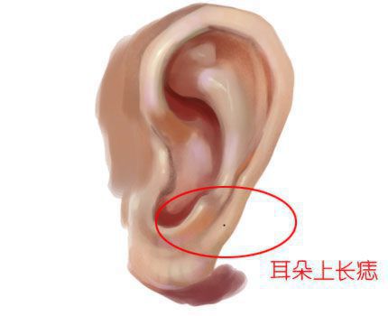 耳朵长上有痣的位置图解，耳朵长痣的位置图解