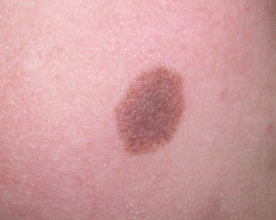 胎记看命运算命图解，最有福气的10处胎记