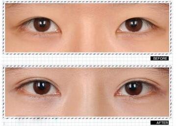 割双眼皮改运，割双眼皮会影响运气吗