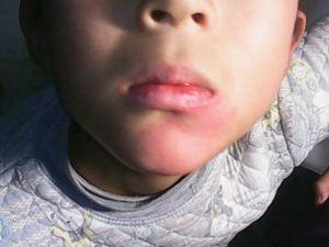 下巴底下的胎记有什么说法，下巴长胎记好不好