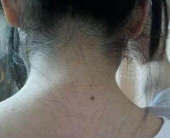 为什么脖子上很多黑痣，脖子后面有很大的黑痣