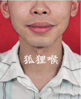 割双眼皮改运，割双眼皮会影响运气吗