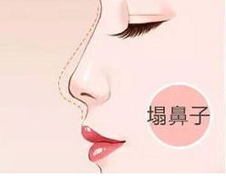 塌鼻子有福气吗，男生为什么很少塌鼻子