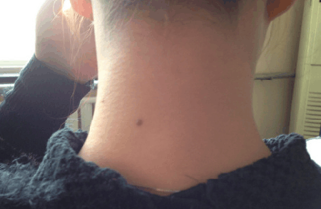 为什么脖子上很多黑痣，脖子后面有很大的黑痣