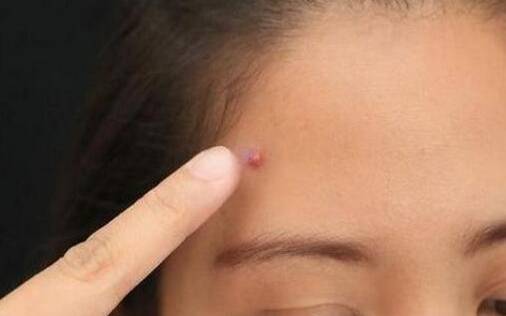 痘痘看你的個性