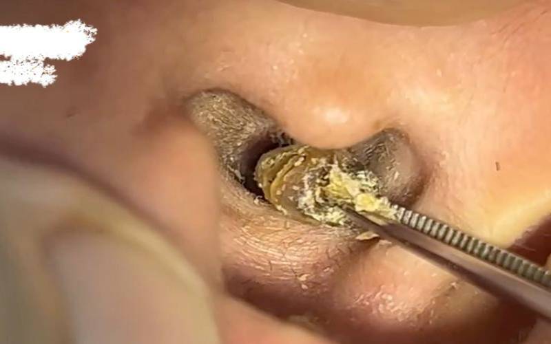 梦见挖耳朵挖出好多东西,梦见抠耳朵抠出一大块耳屎 梦见挖耳朵挖出好多东西,梦见抠耳朵抠出一大块耳屎