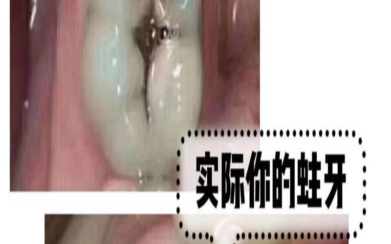 梦见蛀牙有洞变黑（女人梦见蛀牙是吉兆）