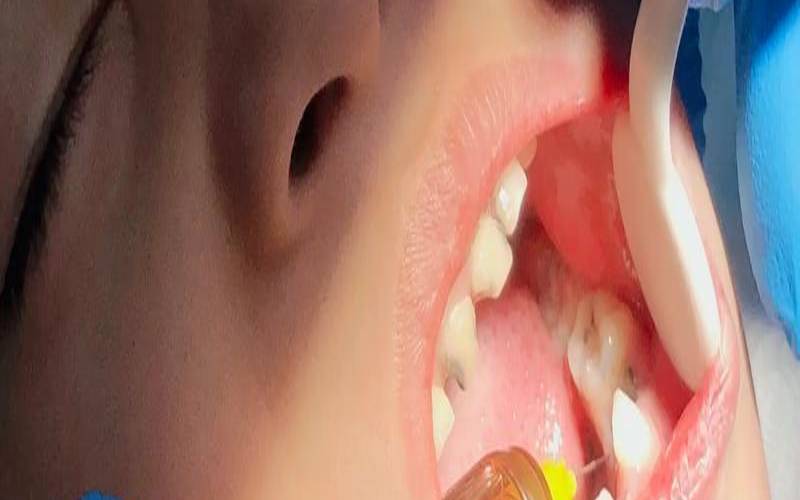 孕妇梦见拔牙齿生男生女,孕妇能不能拔牙 孕妇梦见拔牙齿生男生女,孕妇能不能拔牙