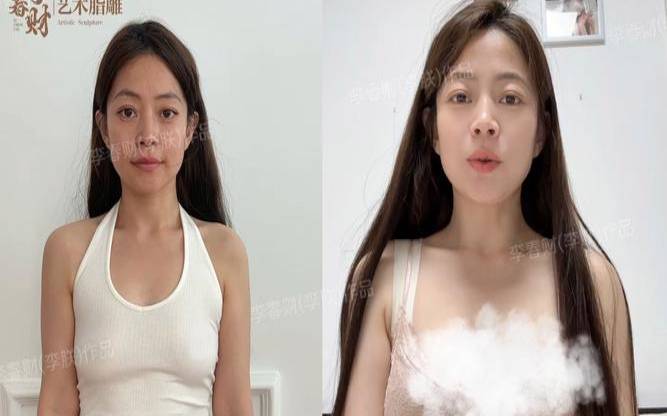 丰胸之后还能哺乳吗,自体脂肪丰胸经历亲身