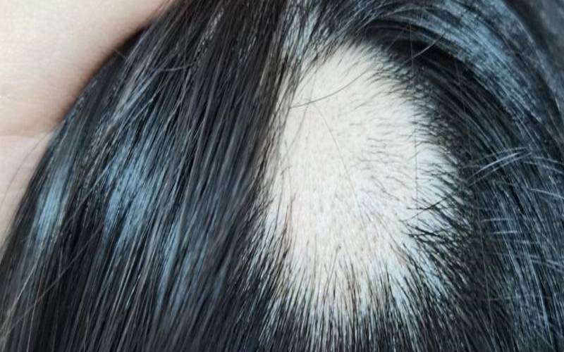 女性做梦头顶秃了一大块（做梦掉大把头发是咋回事）