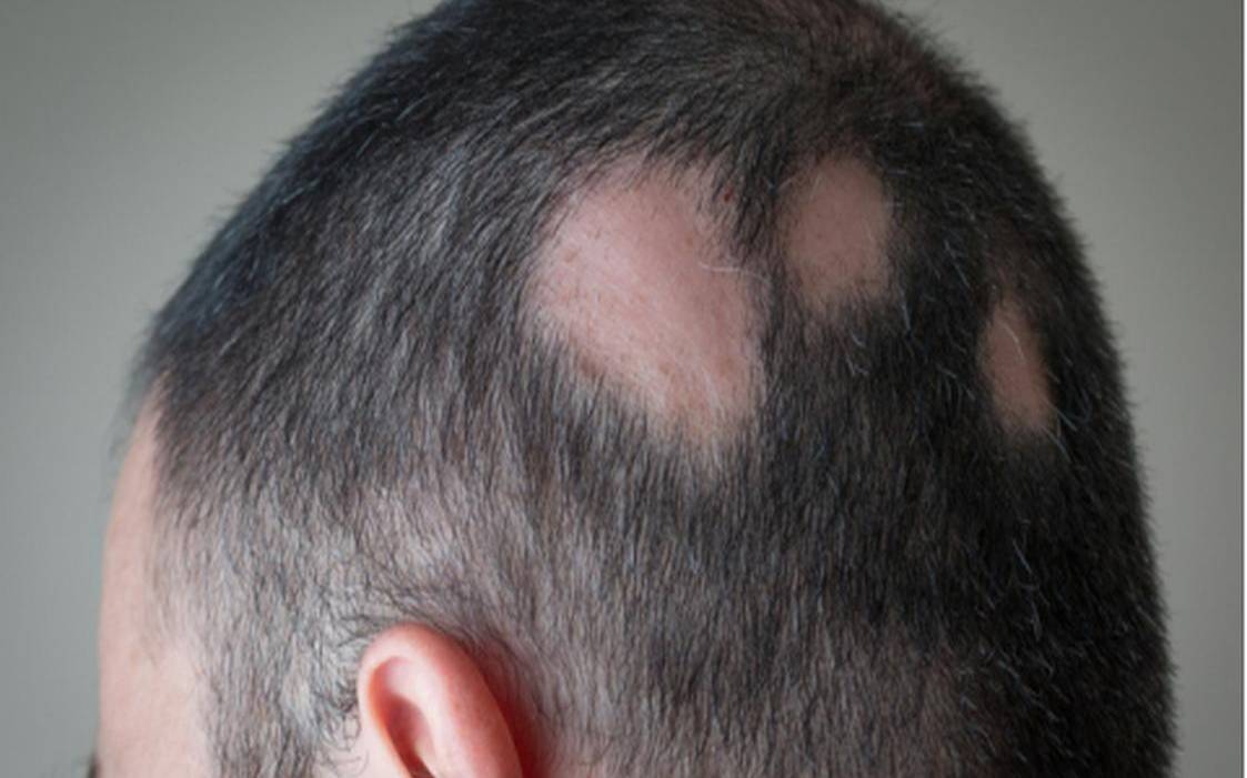 梦见自己头顶秃了几块（梦见头顶秃了一片露头皮）