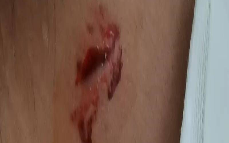 额头受伤有什么说法（额头刮伤会影响运势吗）