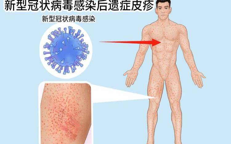 新型冠状病毒的病发症（新型冠状病毒最新症状表现）